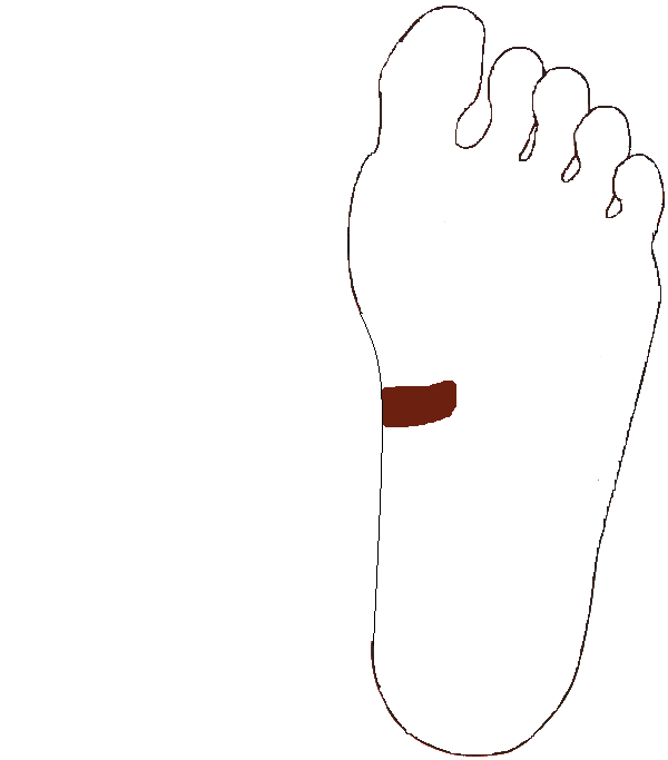 Patkóbél. Bal talp