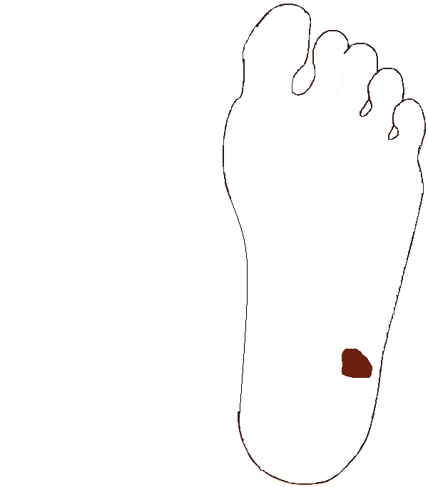 Szigmabél. Bal talp