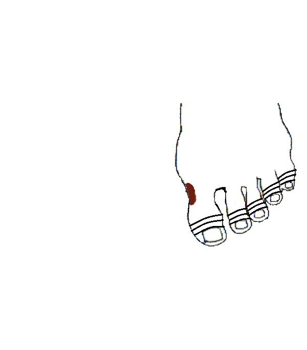 Torok, Garat. Bal lábfej