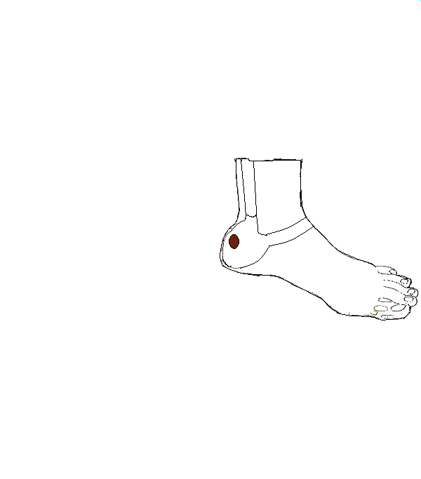 Végbélnyilás. Bal belső