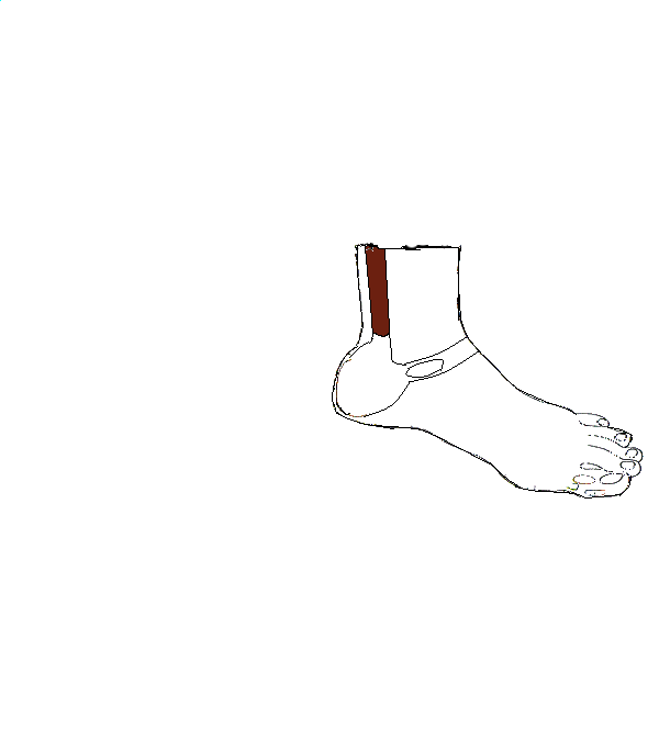 Végbél, Aranyér. Bal lábszár belső