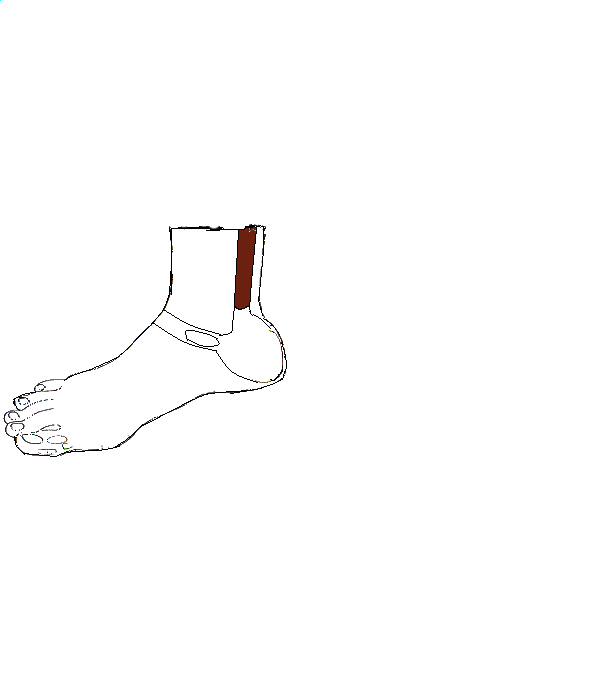 Végbél, Aranyér. Jobb lábszár belső