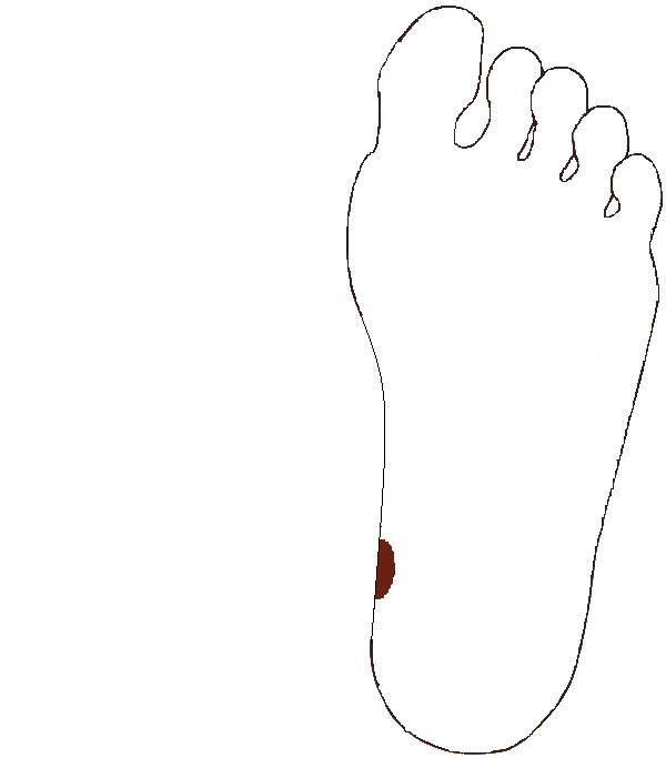 Végbélnyilás. Bal talp