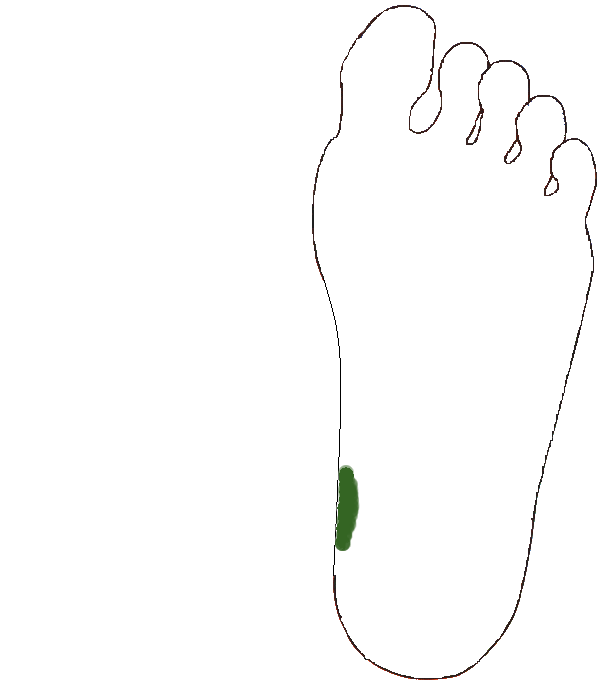 Végbél aranyér. Bal talp