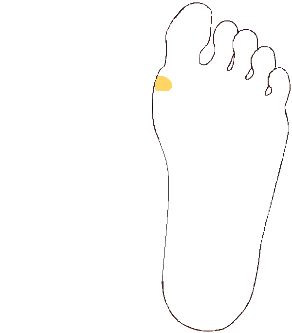 Mellékpajzsmirigy. Bal talp