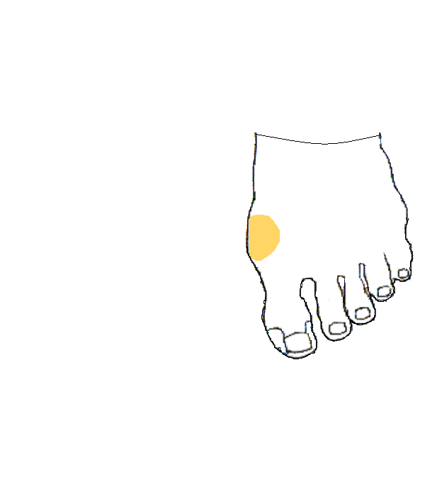 Pajzsmirigy. Bal lábfej