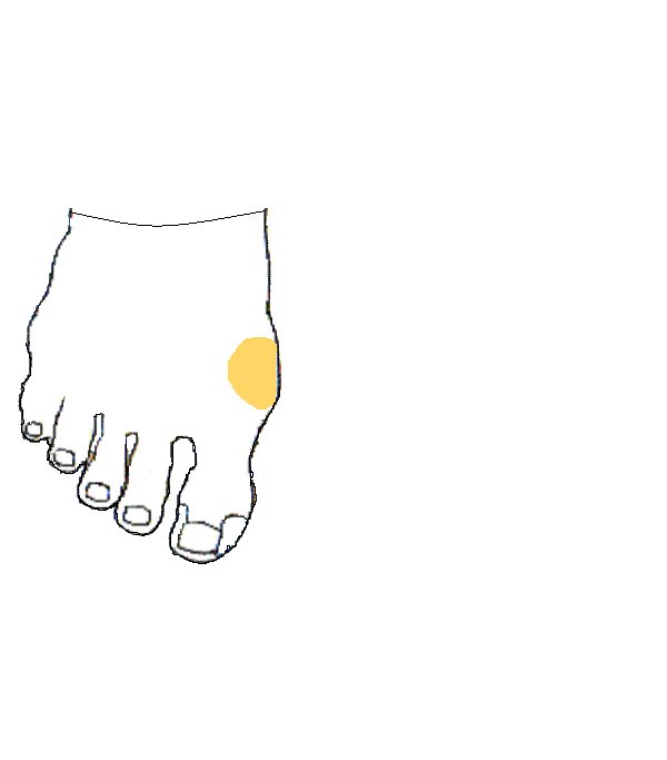 Pajzsmirigy. Jobb lábfej